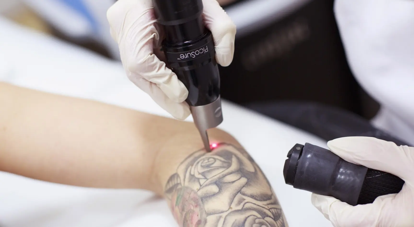 Safe Tattoo Removal in Seattle
